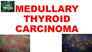 MEDULLARY THYROID CARCINOMA  Gross Microscopic amp Clinical features [upl. by Atinaej575]