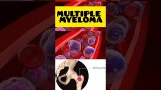 Multiple myeloma multiplemyeloma malayalam cancer hypercalcaemia high calcium genetics [upl. by Teemus]