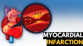 Myocardial Infarction Causes Signs and Symptoms Diagnosis and Treatment [upl. by Inram]