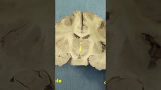 Caudal diencephalon Thalamus and subthalamusneuroanatomy forebrain anatomy brainhumanbrain [upl. by Tsepmet288]