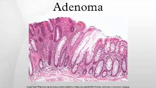 Adenoma [upl. by Arbed]