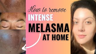 How to Remove Melasma from Face Permanently at Home I Melasma Removal Treatment [upl. by Bekah]