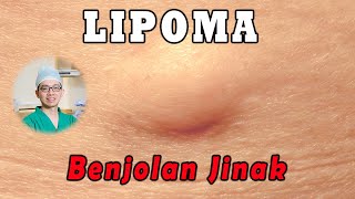 LIPOMA Tumor Jinak  Benjolan Lunak [upl. by Moselle]