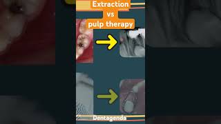 Extraction vs pulp therapy in primary teeth [upl. by Ariak]