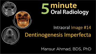 Dentinogenesis Imperfecta Intraoral Radiographic Interpretation [upl. by Lewap]