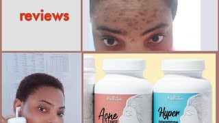 MY HONEST REVIEW ON KALLISTIA ACNE CLEANSE [upl. by Calore535]