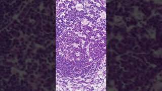 Toxoplasma Lymphadenitis Histology [upl. by Cherey]