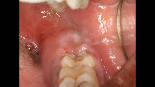 Operculectomy procedure with blade Painful swollen gum around wisdom tooth Pericoronitis Treatment [upl. by Abigail]