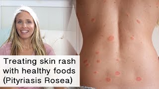 Treating skin rash and inflammation with healthy foods Pityriasis Rosea [upl. by Barolet]