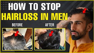 Best HAIR LOSS Treatments For Men Guaranteed Results [upl. by Herrah730]