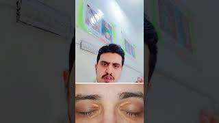 Xanthelasma  Best treatment  shortsfeed [upl. by Iggep]