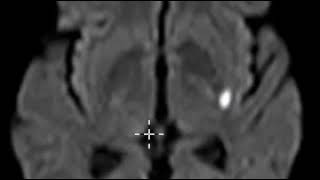 Acute lacunar infarction basal ganglia [upl. by Ferreby]