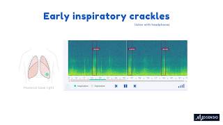 Lung sounds  Early inspiratory crackles [upl. by Adiol]