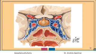 Apoplejia pituitaria [upl. by Mobley]