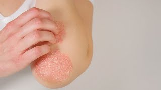 Tratamientos para la psoriasis [upl. by Leff682]