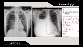 Pneumothorax vs Pleural effusion [upl. by Poock]