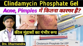 Clindamycin phosphate gel usp  clindamycin phosphate gel  clindac a gel how to use [upl. by Lorant]