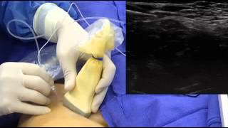 UltrasoundGuided Femoral Nerve Block [upl. by Belden635]