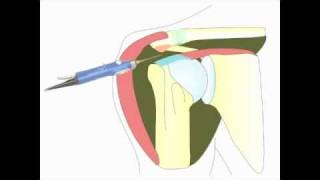 Acromioplastie arthroscopique de lépaule pour tendinite [upl. by Ztirf]