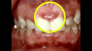 How Periodontal Disease Affects Pregnancy  Lake Merritt Dental Oakland CA [upl. by Williamson569]