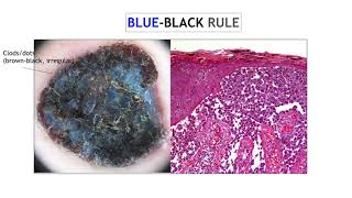 Nodular melanoma  Dr Ketty Peris [upl. by Hplodur]