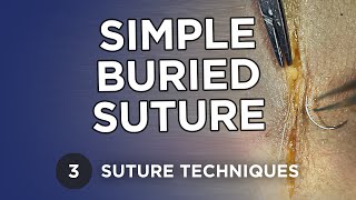 Simple Buried Suture  Learn Suture Techniques [upl. by Etnwahs]