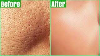 How To Get Rid Of LARGE PORES PERMANENTLY 100 Works Shrink amp Get Clear Glass Skin Naturally [upl. by Eyot]