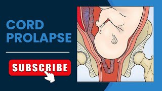 cord prolapse causes signs video nursingdegree obg education biology [upl. by Gardiner977]