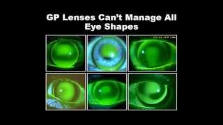 Build Your Practice with Specialty RGP Lenses [upl. by Samaria]