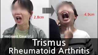 Trismus  Rheumatoid Arthritis  개구장애  류마티스 관절염 치료사례 [upl. by Gerkman]