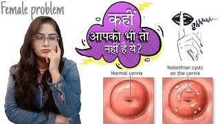 What is Nabothian cysts   Causes  Symptoms  Treatment  By Dr Vanshika saxena [upl. by Nosreve]