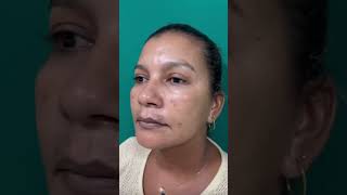 Best Dark Spots Removal for Flawless Skin darkspotsolution darkspotsremover darkspotsonface [upl. by Mariette]