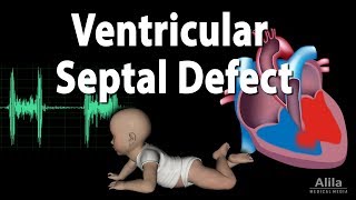 Ventricular Septal Defect Animation [upl. by Joaquin]