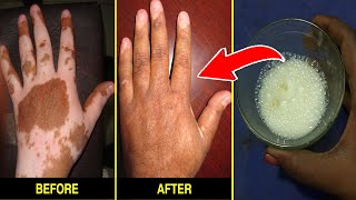 7 நாளில் வெண்புள்ளி மறைய வீட்டு வைத்தியம்  venpulli treatment in tamil [upl. by Colet231]