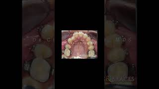 Braces treatment timelapse 2 dentist bracing smile orthodontist mtbraces dentalclinic bracket [upl. by Angelika]