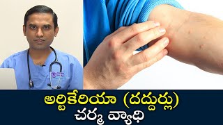 Urticaria skin disease  Samayam Telugu [upl. by Noyrb]