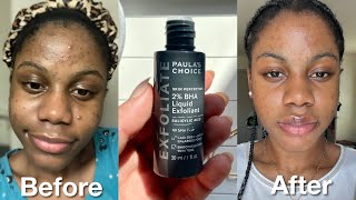 I Tried Paulas Choice Skin Perfecting 2 BHA Liquid Exfoliant For 2 Weeks  Before amp after results [upl. by Tarabar738]