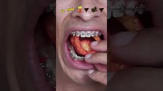 what happens when you eat spicy chips with braces [upl. by Fabri]