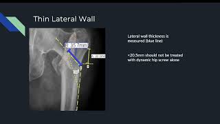 5 Intertrochanteric Femur Fractures with Marquisha [upl. by Asiak]