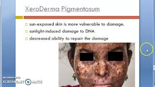 Pathology 761 d Skin XeroDerma Pigmentosum Stratum spinosum pre malignant lesion melanin [upl. by Lonee600]