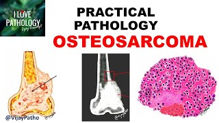 OSTEOSARCOMA Clinical  Radiological features amp Morphology [upl. by Vincenz535]