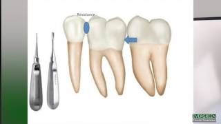 How to make molar extractions easier [upl. by Sawyor409]