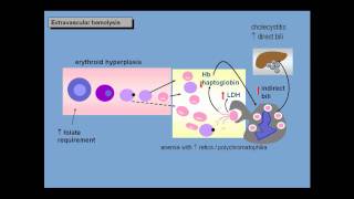 Anemia of increased red cell destruction loss [upl. by Einnaej]