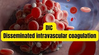 DIC Disseminated intravascular coagulation [upl. by Prasad335]