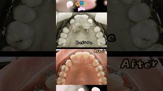 The Braces process dental orthodontics dentestry braces [upl. by Karlis]