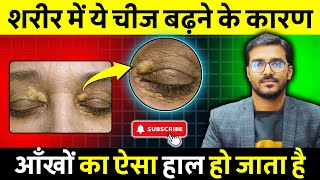 Xanthelasma  आँखों के ऊपर क्योँ चर्बी जमा हो जाती है   Homeopathic Medicine for Xanthelasma [upl. by Elehcim]