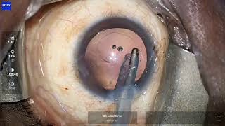 Intraoperative Zonular dialysis managed with Capsular Tension Ring CTR Dr Sheetal Brar [upl. by Cynthie]