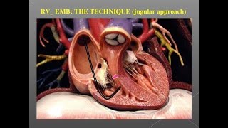 Endomyocardial Biopsy WACP Exam  Cardiology [upl. by Nlocnil885]