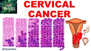 Squamous Intraepithelial lesion amp CANCER CERVIX [upl. by Lenoel727]