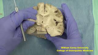 Coronal forebrain first videoneuroanatomy forebrainhypothalamushumanbrainbrainhumanbrain [upl. by Asor]